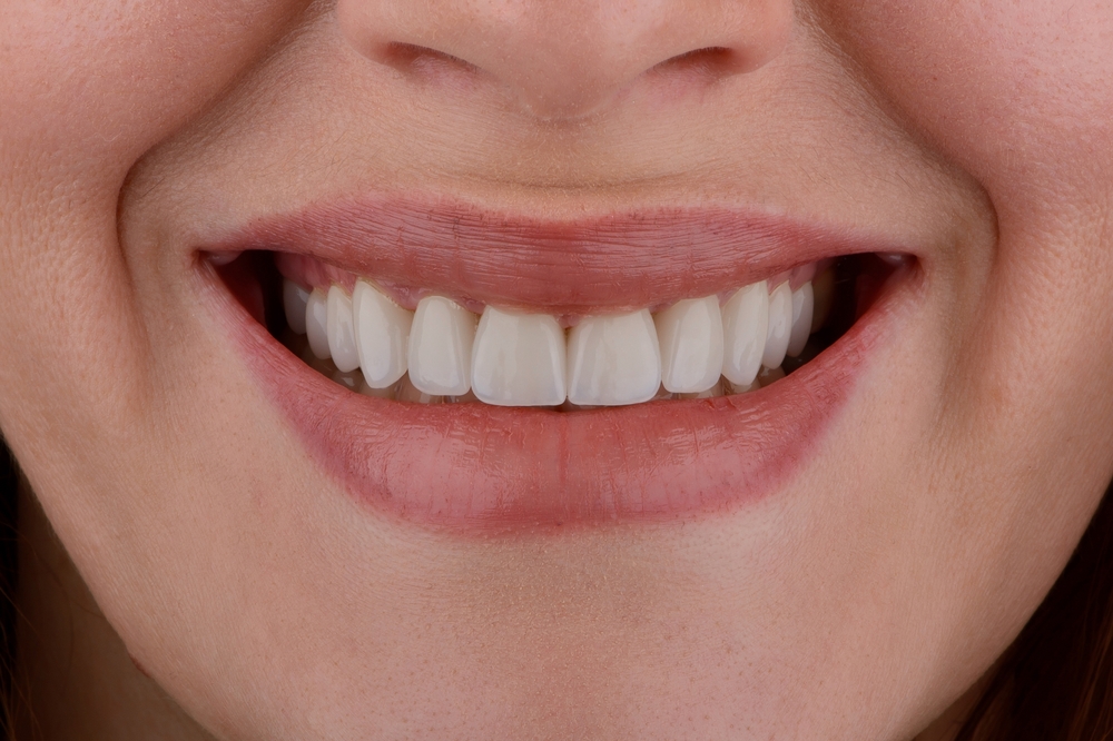 Scotts Valley Dental Patient Female smile makeover by dental ceramic veneer, porcelain laminate veneers.
